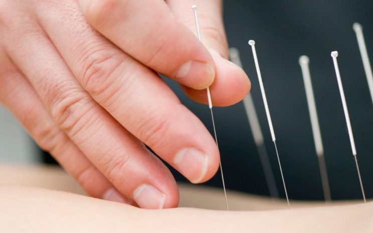 Qué es la acupuntura? - Aetna  Preguntas frecuentes sobre la acupuntura